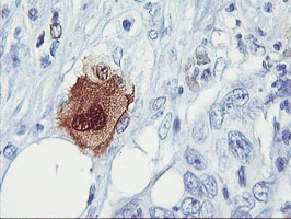 IHC of paraffin-embedded Carcinoma of Human pancreas tissue using anti-SDS mouse monoclonal antibody.