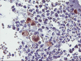 IHC of paraffin-embedded Adenocarcinoma of Human colon tissue using anti-SDS mouse monoclonal antibody.