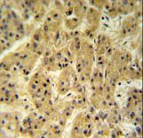 SC24A Antibody IHC of formalin-fixed and paraffin-embedded hepatocarcinoma followed by peroxidase-conjugated secondary antibody and DAB staining.