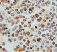 Immunohistochemistry of paraffin-embedded human lymphoma using SEC24A antibody .
