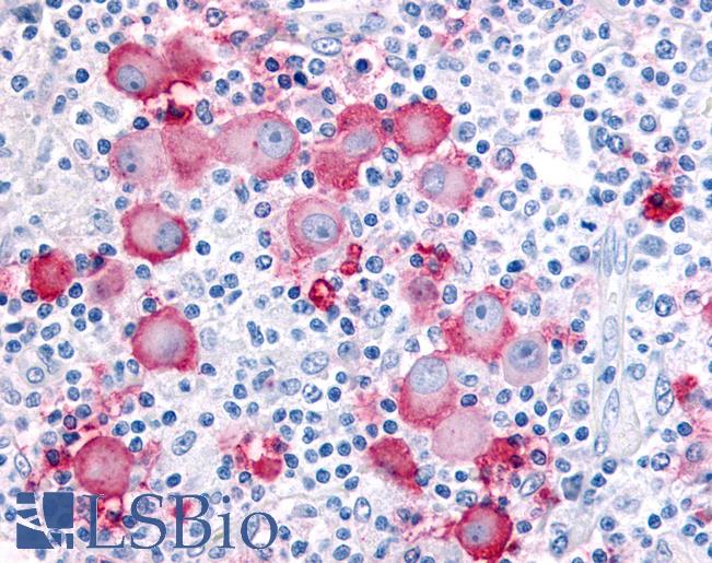 Anti-SEH / EPHX2 antibody IHC of human Skin, Melanoma. Immunohistochemistry of formalin-fixed, paraffin-embedded tissue after heat-induced antigen retrieval.