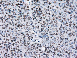 IHC of paraffin-embedded Adenocarcinoma of endometrium tissue using anti-PSMD10 mouse monoclonal antibody. (Dilution 1:50).