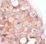 Formalin-fixed and paraffin-embedded human cancer tissue reacted with the primary antibody, which was peroxidase-conjugated to the secondary antibody, followed by DAB staining. This data demonstrates the use of this antibody for immunohistochemistry; clinical relevance has not been evaluated. BC = breast carcinoma; HC = hepatocarcinoma.