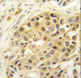 Formalin-fixed and paraffin-embedded human breast carcinoma tissue reacted with SENP3 antibody , which was peroxidase-conjugated to the secondary antibody, followed by DAB staining. This data demonstrates the use of this antibody for immunohistochemistry; clinical relevance has not been evaluated.