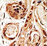 Formalin-fixed and paraffin-embedded human cancer tissue reacted with the primary antibody, which was peroxidase-conjugated to the secondary antibody, followed by AEC staining. This data demonstrates the use of this antibody for immunohistochemistry; clinical relevance has not been evaluated. BC = breast carcinoma; HC = hepatocarcinoma.