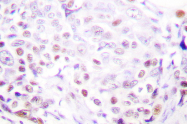 IHC of SENP3 (Y24) pAb in paraffin-embedded human breast carcinoma tissue.