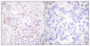 IHC of paraffin-embedded human breast carcinoma tissue, using SENP3 Antibody. The picture on the right is treated with the synthesized peptide.