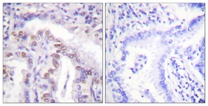 IHC of paraffin-embedded human lung carcinoma, using SENP6 Antibody. The picture on the right is treated with the synthesized peptide.