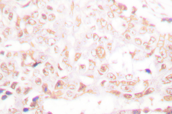 IHC of SENP8 (T191) pAb in paraffin-embedded human breast carcinoma tissue.