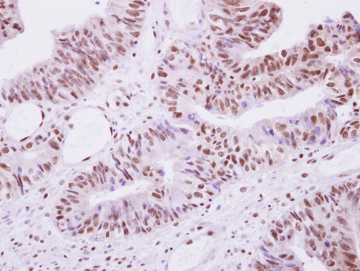 Selenophosphate synthetase 1 antibody detects SEPHS1 protein at nucleus on Colon Carcinoma by immunohistochemical analysis. Sample: Paraffin-embedded Colon Carcinoma. Selenophosphate synthetase 1 antibody dilution:1:500.