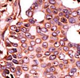 Formalin-fixed and paraffin-embedded human cancer tissue reacted with the primary antibody, which was peroxidase-conjugated to the secondary antibody, followed by DAB staining. This data demonstrates the use of this antibody for immunohistochemistry; clinical relevance has not been evaluated. BC = breast carcinoma; HC = hepatocarcinoma.