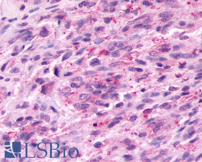 Anti-PROKR2/Prokineticin Receptor 2 antibody IHC of human Brain, Glioblastoma. Immunohistochemistry of formalin-fixed, paraffin-embedded tissue after heat-induced antigen retrieval.