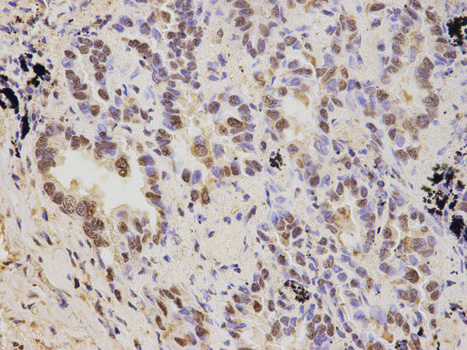 Immunohistochemistry of paraffin-embedded human lung cancer using PSMD2 antibody at dilution of 1:200 (400x lens).