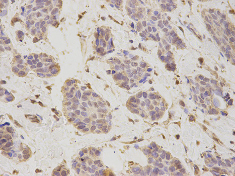Immunohistochemistry of paraffin-embedded human breast cancer using PSMD2 antibody at dilution of 1:200 (400x lens).