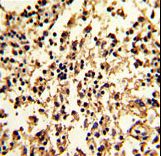 Formalin-fixed and paraffin-embedded human lymph with SERPINA9 Antibody , which was peroxidase-conjugated to the secondary antibody, followed by DAB staining. This data demonstrates the use of this antibody for immunohistochemistry; clinical relevance has not been evaluated.