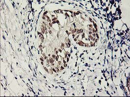 IHC of paraffin-embedded Adenocarcinoma of Human breast tissue using anti-SERPINB13 mouse monoclonal antibody.
