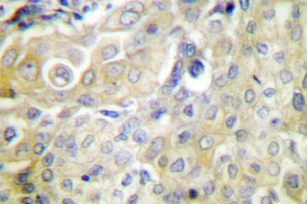 IHC of Maspin (T118) pAb in paraffin-embedded human cervix carcinoma tissue.