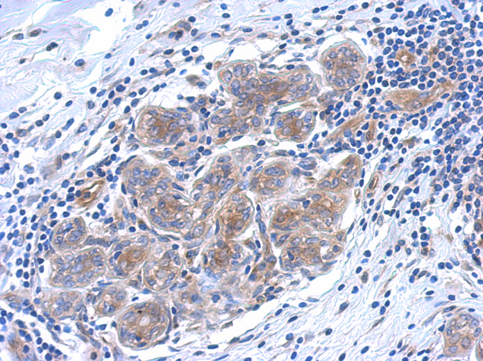 IHC of paraffin-embedded breast ca using SERPINB6 antibody antibody at 1:500 dilution.