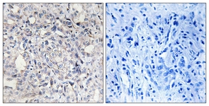 IHC of paraffin-embedded human liver carcinoma tissue, using Heparin Cofactor II Antibody. The picture on the right is treated with the synthesized peptide.