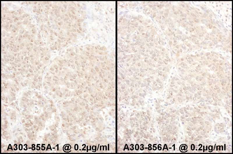 Detection of Human PSMD4 by Immunohistochemistry. Samples: FFPE sections of human lung carcinoma. Antibody: Affinity purified rabbit anti-PSMD4 used at a dilution of 1:5000 (0.2 ug/ml). Detection: DAB.