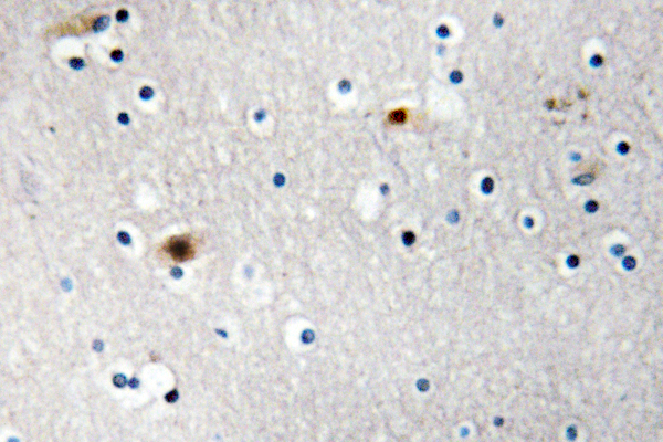IHC of TAF I p48 (R318) pAb in paraffin-embedded human brain carcinoma tissue.