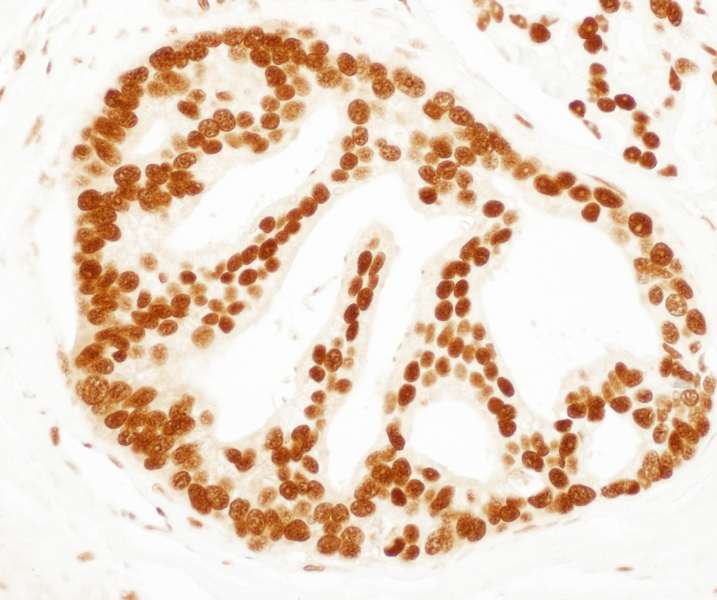 Detection of Human SET by Immunohistochemistry. Sample: FFPE section of human prostate carcinoma. Antibody: Affinity purified rabbit anti-SET used at a dilution of 1:200 (1 ug/ml). Detection: DAB.