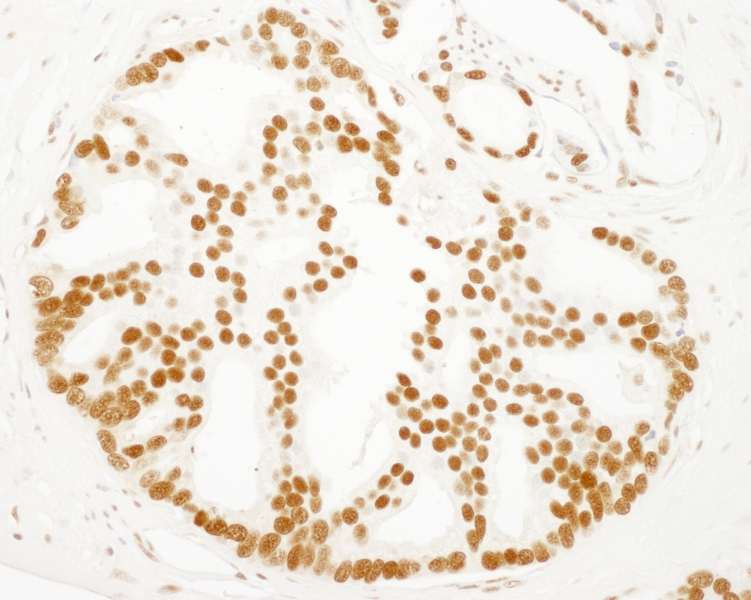 Detection of Human SET by Immunohistochemistry. Sample: FFPE section of human prostate carcinoma. Antibody: Affinity purified rabbit anti-SET used at a dilution of 1:250.