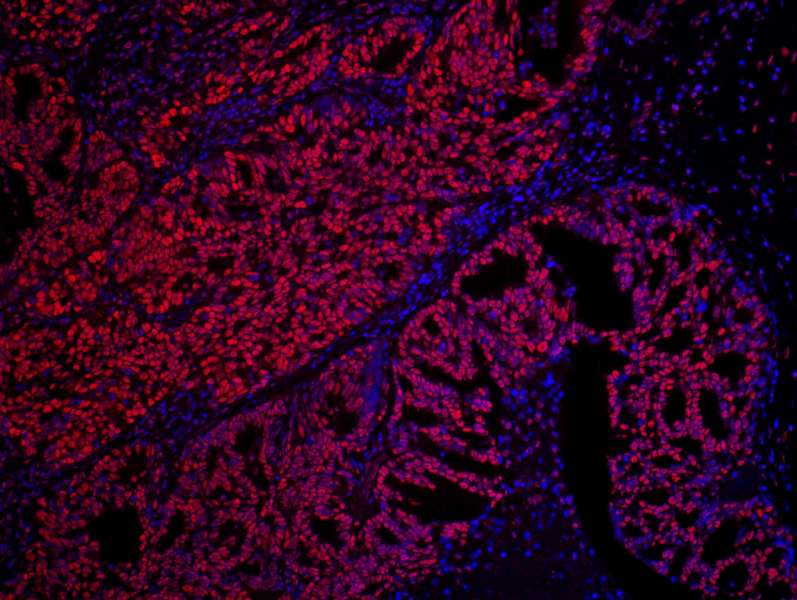Detection of Human SET by Immunohistochemistry. Sample: FFPE section of human prostate carcinoma. Antibody: Affinity purified rabbit anti-SET used at a dilution of 1:100. Detection: Red-fluorescent Goat anti-Rabbit IgG-heavy and light chain cross-adsorbed Antibody DyLight 594 Conjugated (A120-601D4) used at a dilution of 1:100.