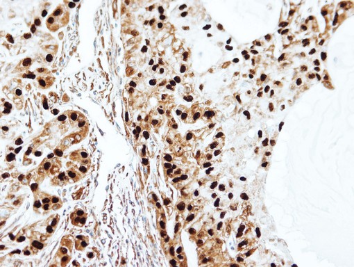IHC of paraffin-embedded A549 xenograft using SET antibody at 1:100 dilution.