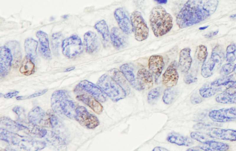 Detection of Human hSET1 by Immunohistochemistry. Sample: FFPE section of human colon carcinoma. Antibody: Affinity purified rabbit anti-hSET1 used at a dilution of 1:1000 (1 Detection: DAB.