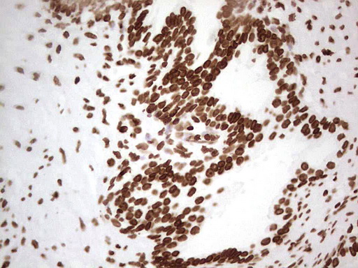 IHC of paraffin-embedded Human prostate tissue using anti-SETD1A mouse monoclonal antibody. (Heat-induced epitope retrieval by 1 mM EDTA in 10mM Tris, pH8.5, 120°C for 3min).