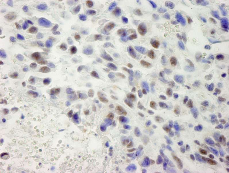 Detection of Mouse hSET1 by Immunohistochemistry. Sample: FFPE section of mouse squamous cell carcinoma. Antibody: Affinity purified rabbit anti-hSET1 used at a dilution of 1:250.