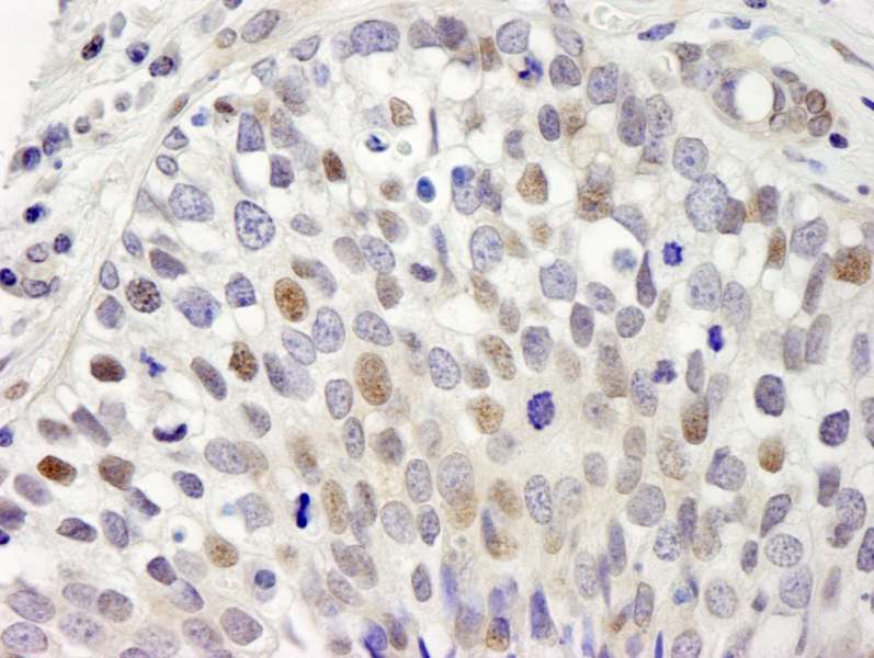 Detection of Human hSET1 by Immunohistochemistry. Sample: FFPE section of human breast adenocarcinoma. Antibody: Affinity purified rabbit anti-hSET1 used at a dilution of 1:250.