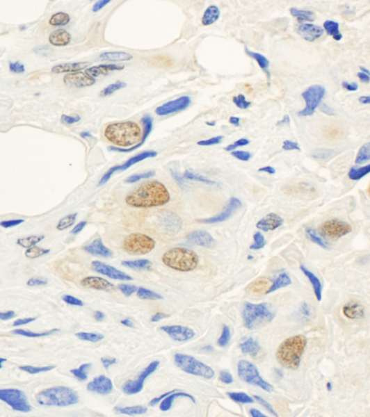 Detection of Human hSET1 by Immunohistochemistry. Sample: FFPE section of human breast carcinoma. Antibody: Affinity purified rabbit anti-hSET1 used at a dilution of 1:1000 (1 ug/ml). Detection: DAB.