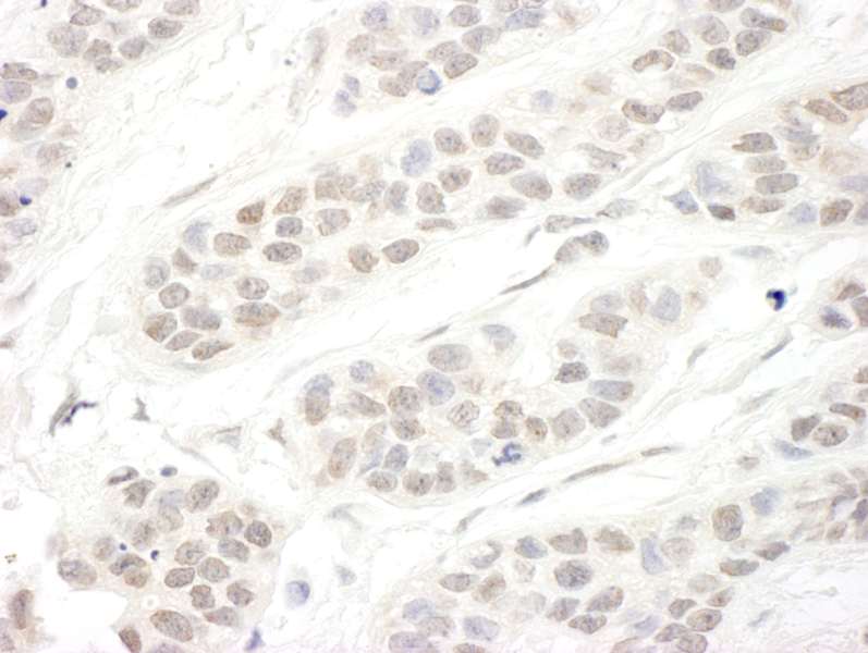 Detection of Human hSET1B by Immunohistochemistry. Sample: FFPE section of human breast carcinoma. Antibody: Affinity purified rabbit anti-hSET1B used at a dilution of 1:1000 (1 Detection: DAB.