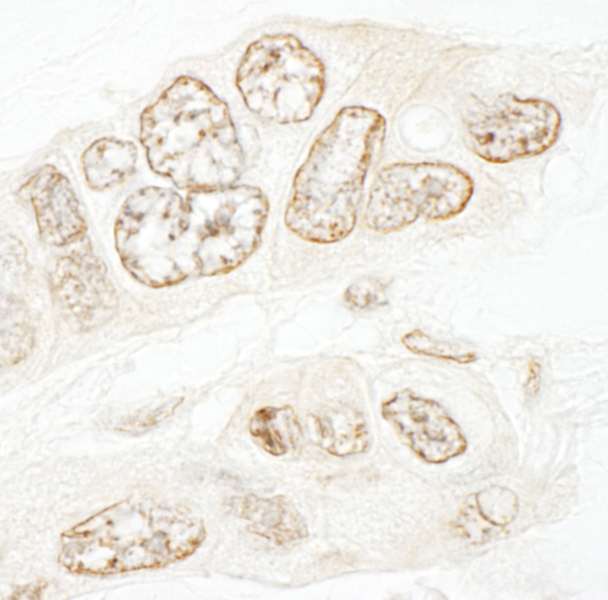 Detection of Human hSET1B by Immunohistochemistry. Sample: FFPE section of human ovarian carcinoma. Antibody: Affinity purified rabbit anti-hSET1B used at a dilution of 1:1000 (1 Detection: DAB.