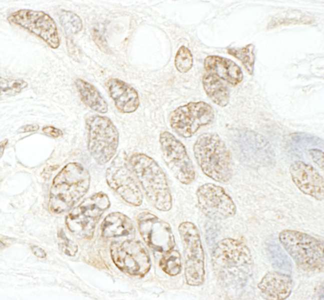 Detection of Human hSET1B by Immunohistochemistry. Sample: FFPE section of human ovarian carcinoma. Antibody: Affinity purified rabbit anti-hSET1B used at a dilution of 1:250.