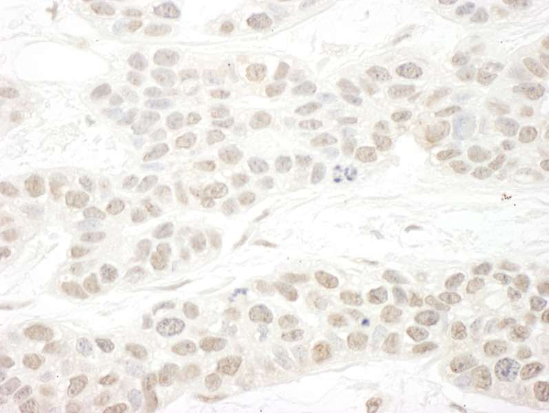 Detection of Human hSET1B by Immunohistochemistry. Sample: FFPE section of human breast carcinoma. Antibody: Affinity purified rabbit anti-hSET1B used at a dilution of 1:250.