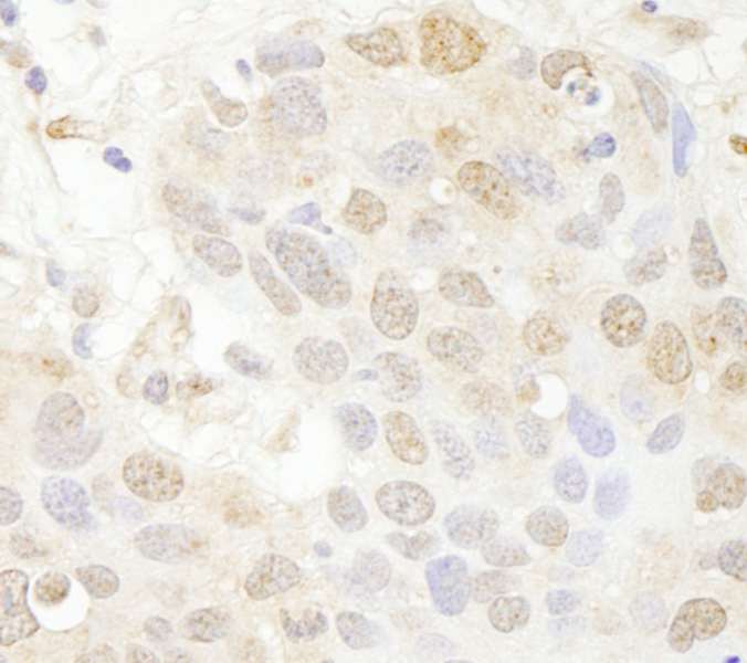 Detection of Human SET7 by Immunohistochemistry. Sample: FFPE section of human breast carcinoma. Antibody: Affinity purified rabbit anti-SET7 used at a dilution of 1:250.