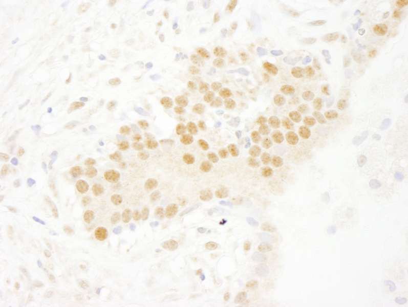 Detection of Human SET7 by Immunohistochemistry. Sample: FFPE section of human prostate carcinoma. Antibody: Affinity purified rabbit anti-SET7 used at a dilution of 1:250.