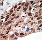 Formalin-fixed and paraffin-embedded human cancer tissue reacted with the primary antibody, which was peroxidase-conjugated to the secondary antibody, followed by DAB staining. This data demonstrates the use of this antibody for immunohistochemistry; clinical relevance has not been evaluated. BC = breast carcinoma; HC = hepatocarcinoma.