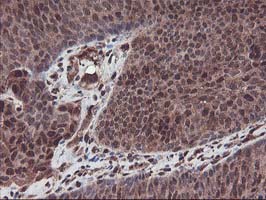 IHC of paraffin-embedded Carcinoma of Human bladder tissue using anti-SETD7 mouse monoclonal antibody. (Heat-induced epitope retrieval by 10mM citric buffer, pH6.0, 100C for 10min).