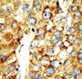 Formalin-fixed and paraffin-embedded human cancer tissue reacted with the primary antibody, which was peroxidase-conjugated to the secondary antibody, followed by DAB staining. This data demonstrates the use of this antibody for immunohistochemistry; clinical relevance has not been evaluated. BC = breast carcinoma; HC = hepatocarcinoma.