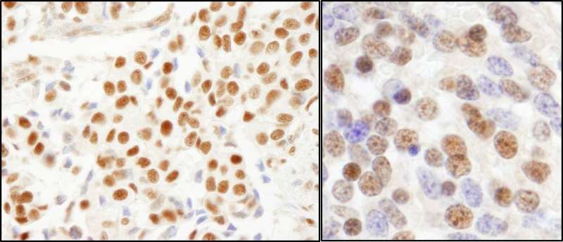 Detection of Human and Mouse SF3a120/SAP114 by Immunohistochemistry. Sample: FFPE sections of human breast carcinoma (left) and mouse teratoma (right). Antibody: Affinity purified rabbit anti-SF3a120/SAP114 used at a dilution of 1:200 (1 ug/ml). Detection: DAB.