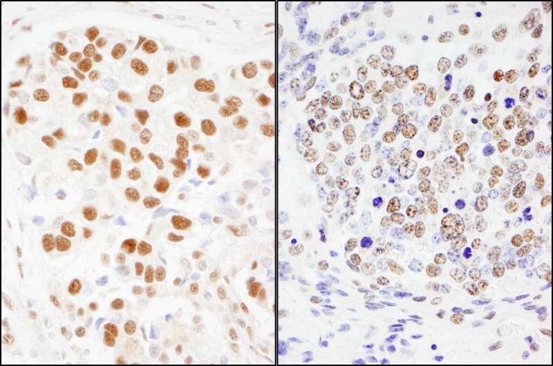 Detection of Human and Mouse SF3a120/SAP114 by Immunohistochemistry. Sample: FFPE sections of human breast carcinoma (left) and mouse teratoma (right). Antibody: Affinity purified rabbit anti-SF3a120/SAP114 used at a dilution of 1:200 (1 ug/ml). Detection: DAB.