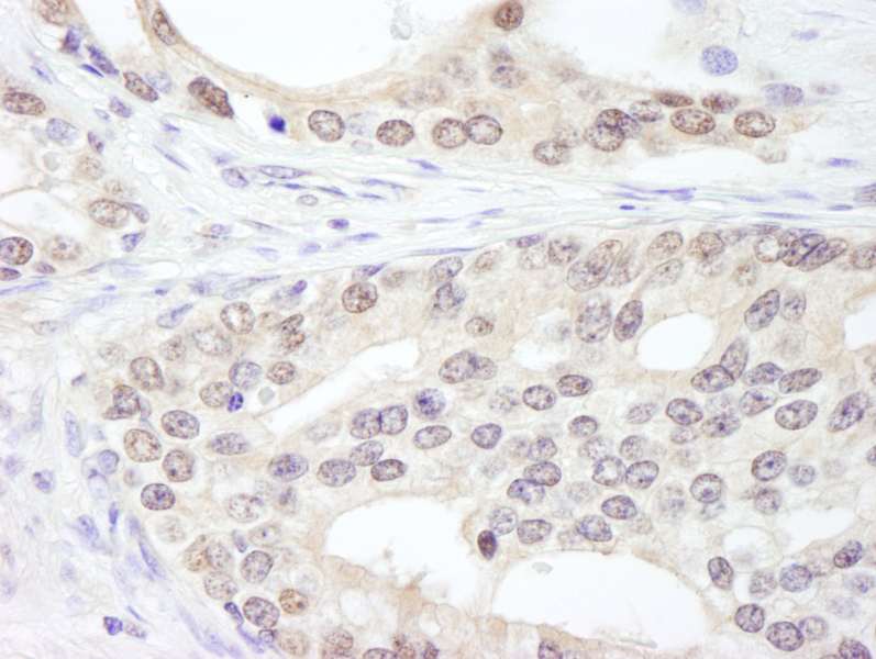 Detection of Human SF3a120/SAP114 by Immunohistochemistry. Sample: FFPE section of human prostate carcinoma. Antibody: Affinity purified rabbit anti-SF3a120/SAP114 used at a dilution of 1:200 (1 ug/ml). Detection: DAB.