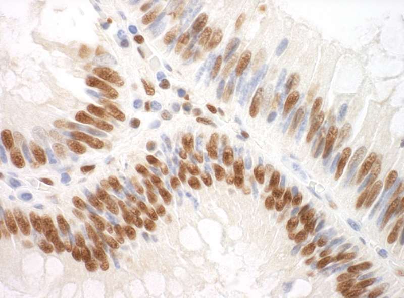 Detection of Human SF3A3 by Immunohistochemistry. Sample: FFPE section of human colon carcinoma. Antibody: Affinity purified rabbit anti-SF3A3 used at a dilution of 1:200 (1 ug/ml). Detection: DAB.