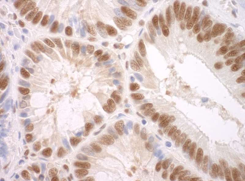 Detection of Human SF3A3 by Immunohistochemistry. Sample: FFPE section of human colon carcinoma. Antibody: Affinity purified rabbit anti-SF3A3 used at a dilution of 1:250.