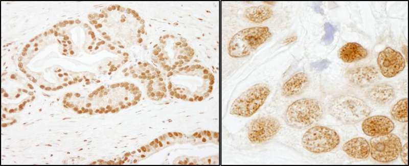 Detection of Human SF3b155/SAP155 by Immunohistochemistry. Sample: FFPE section of human prostate carcinoma. Antibody: Affinity purified rabbit anti-SF3b155/SAP155 used at a dilution of 1:200 (1 ug/ml). Detection: DAB.