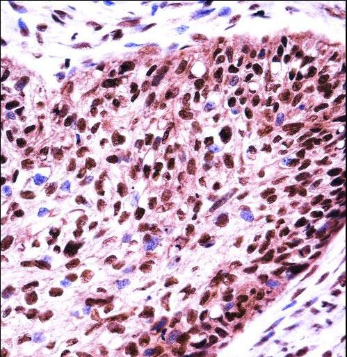 SF3B1 Antibody immunohistochemistry of formalin-fixed and paraffin-embedded human esophagus carcinoma followed by peroxidase-conjugated secondary antibody and DAB staining.